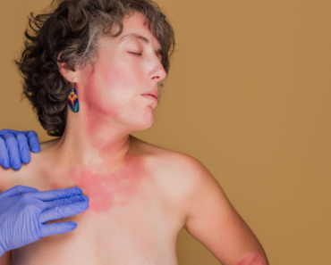 Home Remedies for Eczema, Rosacea & Dandruff: Quick Help