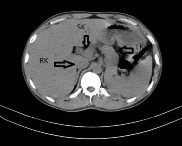 Diagnostic dilemma: A man’s back pain led to the discovery of a third kidney