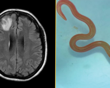 Diagnostic dilemma: A parasite never before seen in humans was behind a woman’s lung infection, organ damage and oblivion