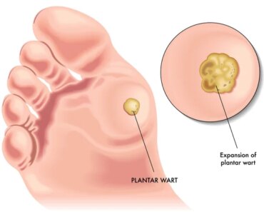 Feet ache? Sneaky Plantar Wart Symptoms You’re Missing