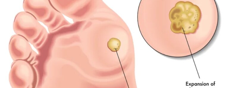 Feet ache? Sneaky Plantar Wart Symptoms You’re Missing