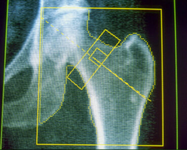 GLP-1s may increase the risk of osteoporosis and gout, new research finds