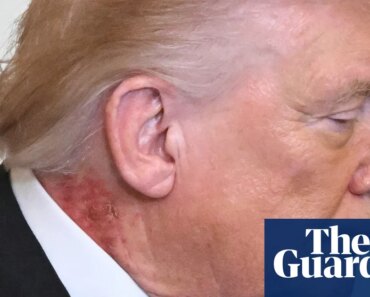 Rash on Trump’s neck due to ‘preventive’ skin treatment, White House says | donald trump Rash on Trump’s neck due to ‘preventive’ skin treatment, White House says | donald trump
