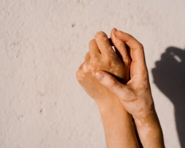 Ruxolitinib: Landmark vitiligo cream targets immune cells that disrupt pigmentation