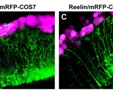 Single protein can dramatically change the trajectory of Alzheimer’s disease