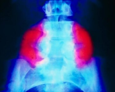 Stem cell patch reverses brain damage in fetuses with spina bifida Stem cell patch reverses brain damage in fetuses with spina bifida